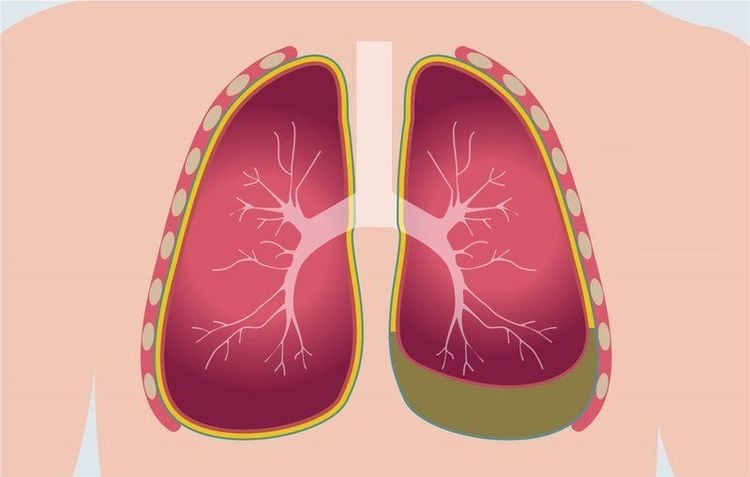 X-quang xuất huyết phổi ở trẻ sơ sinh