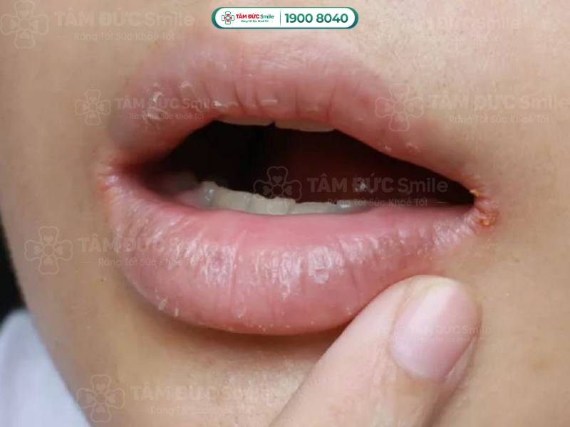 Dưỡng ẩm môi đúng cách