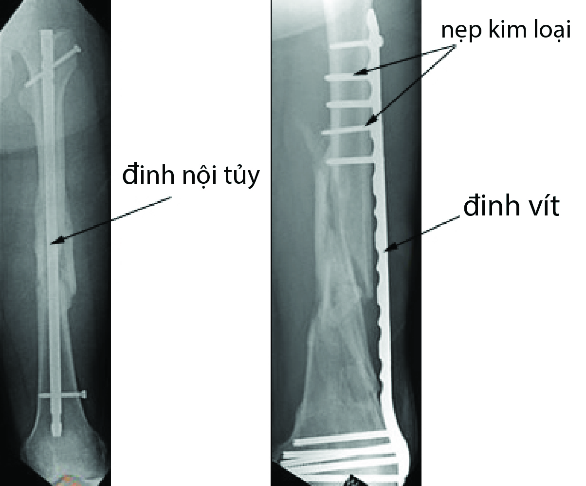 Chụp X-quang gãy thân xương đùi