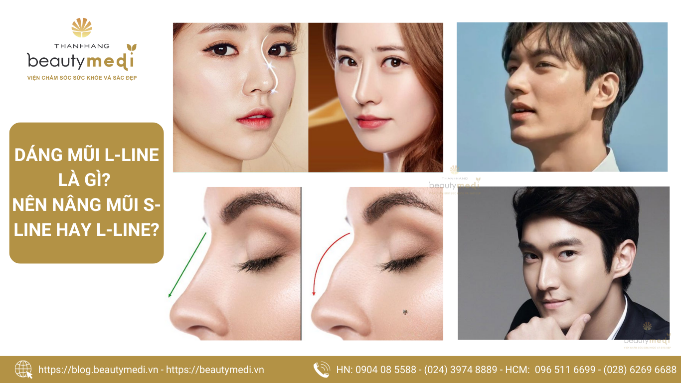 Mũi L-Line điển hình