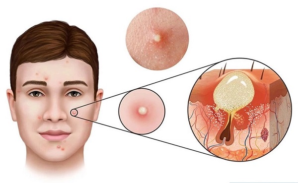 mụn bọc có mủ