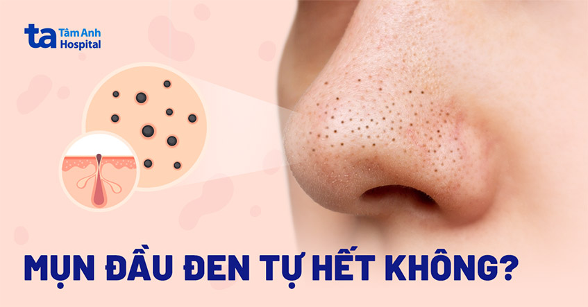 Tình trạng mụn đầu đen kéo dài