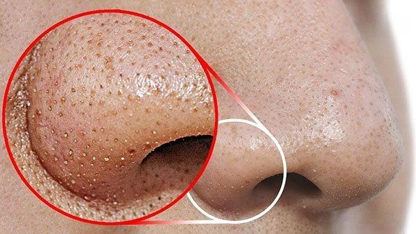 Mụn đầu đen là gì?