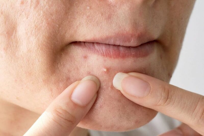 Hình ảnh mụn đầu trắng