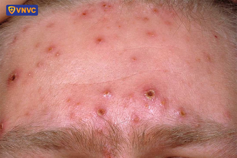 Mụn nước thủy đậu trên trán người bệnh