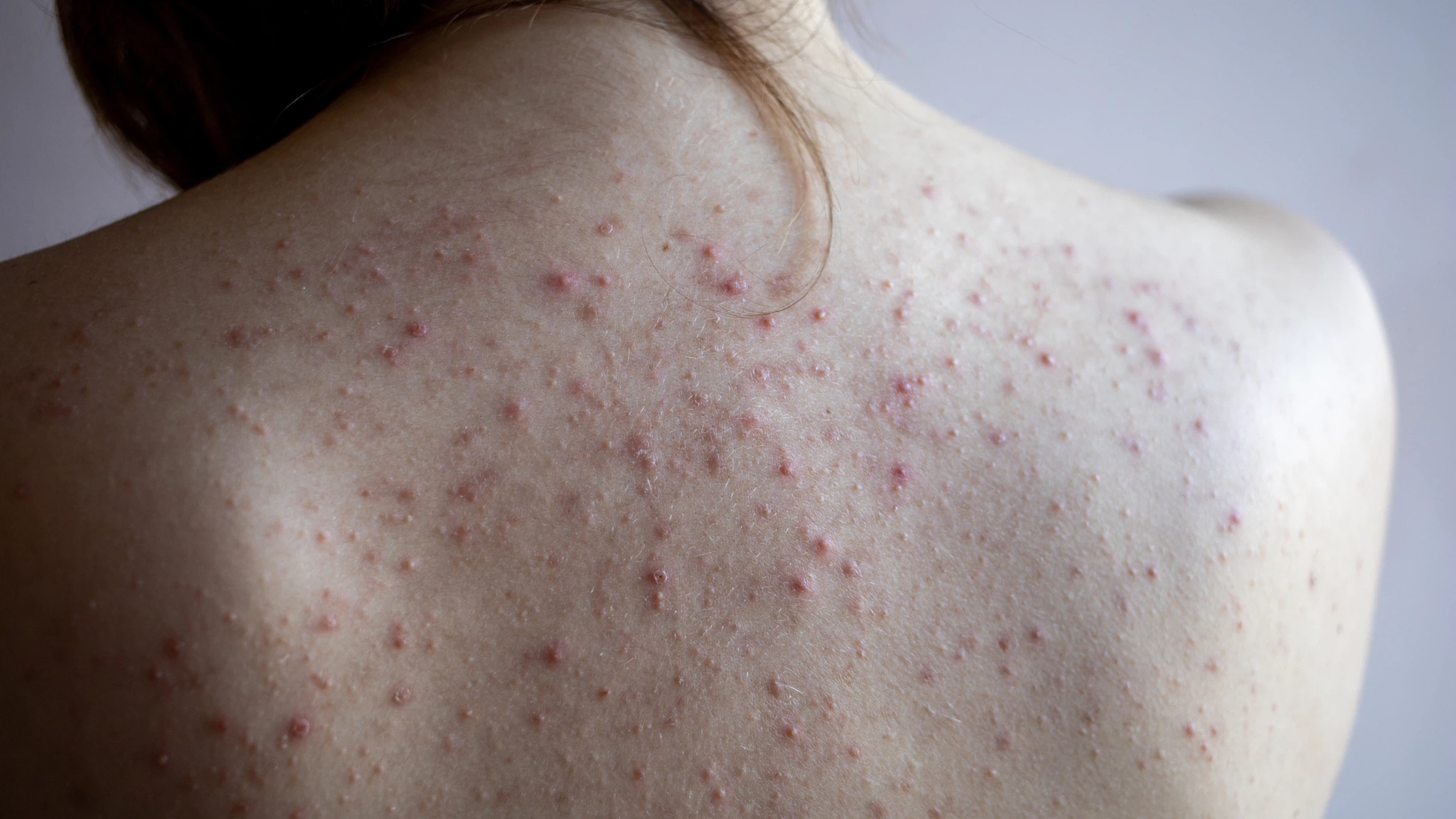 Tình trạng mụn lưng phổ biến