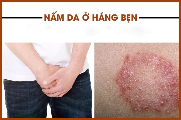Nấm Bẹn: Nguyên Nhân, Triệu Chứng và Cách Điều Trị Hiệu Quả 7 Hình ảnh vùng da bị nấm bẹn