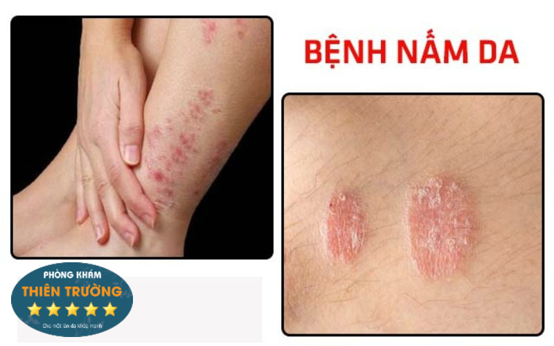 Hình ảnh nấm Candida vùng nếp gấp da