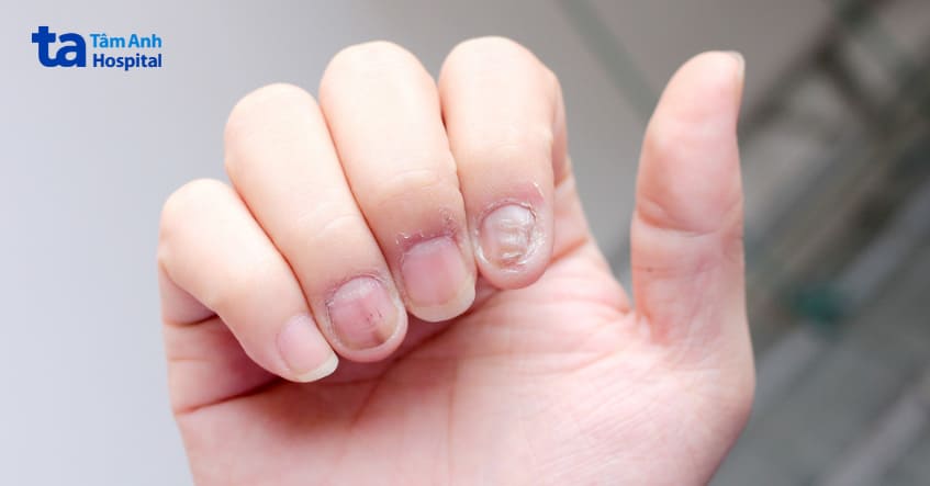 Móng tay giòn và dễ gãy do nấm móng