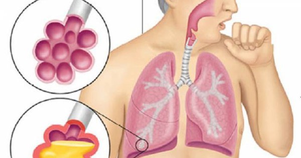 Nguy hiểm của nấm phổi Aspergillus