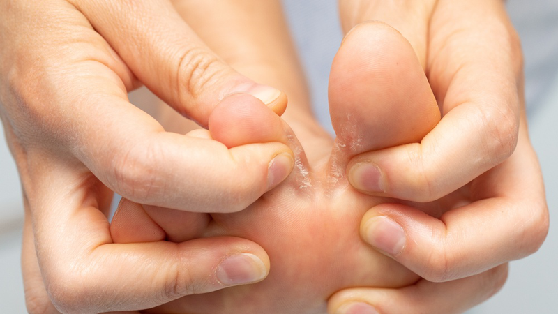 Nấm kẽ: Nguyên nhân, triệu chứng và cách điều trị hiệu quả 7 Triệu chứng nấm kẽ ở chân