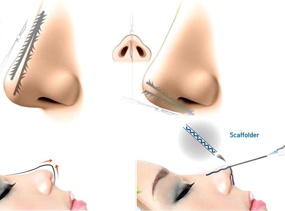 Quy trình cấy chỉ nâng mũi