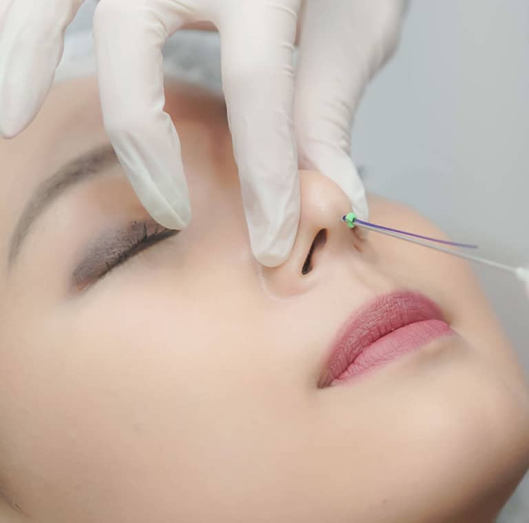 Nâng mũi bằng chỉ collagen