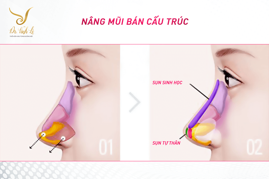 Nâng mũi cấu trúc là gì? Phân biệt với nâng mũi bán cấu trúc 7 quy trình nâng mũi cấu trúc
