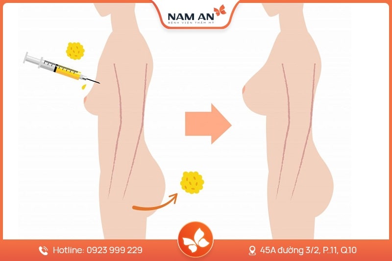 Nâng Ngực Bằng Mỡ Tự Thân: Ưu Và Nhược Điểm Bạn Không Thể Bỏ Qua 7 nâng ngực bằng mỡ tự thân