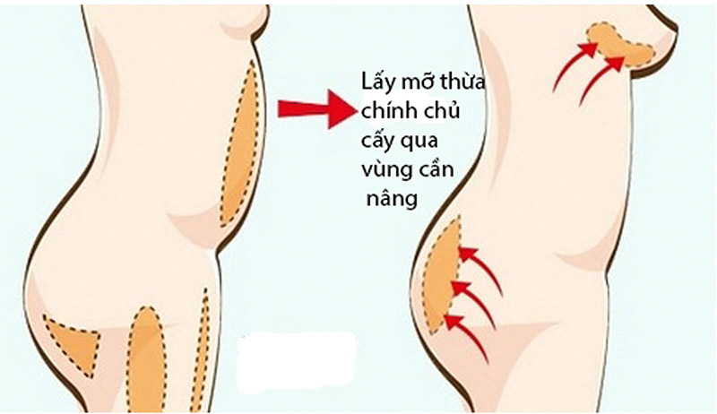 Nâng Ngực Bằng Mỡ Tự Thân: Ưu Và Nhược Điểm Bạn Không Thể Bỏ Qua 8 ưu điểm nâng ngực bằng mỡ tự thân