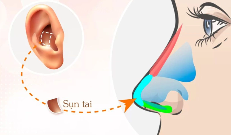 Nâng mũi bằng sụn tai
