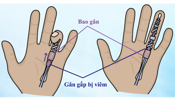 Minh họa ngón tay bị bật