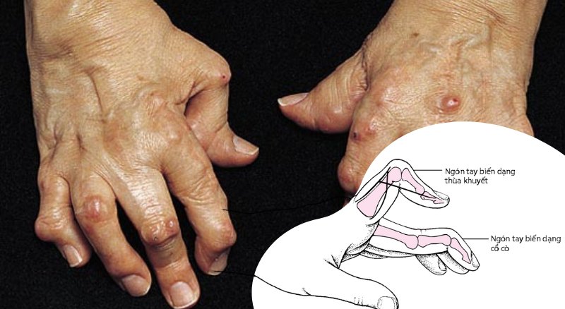 dị dạng thùa khuyết áo ở trẻ nhỏ