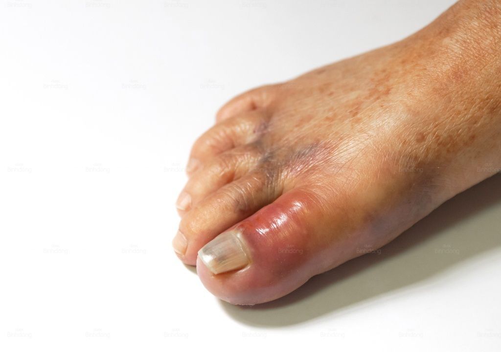 Người bị sưng khớp tay do chấn thương