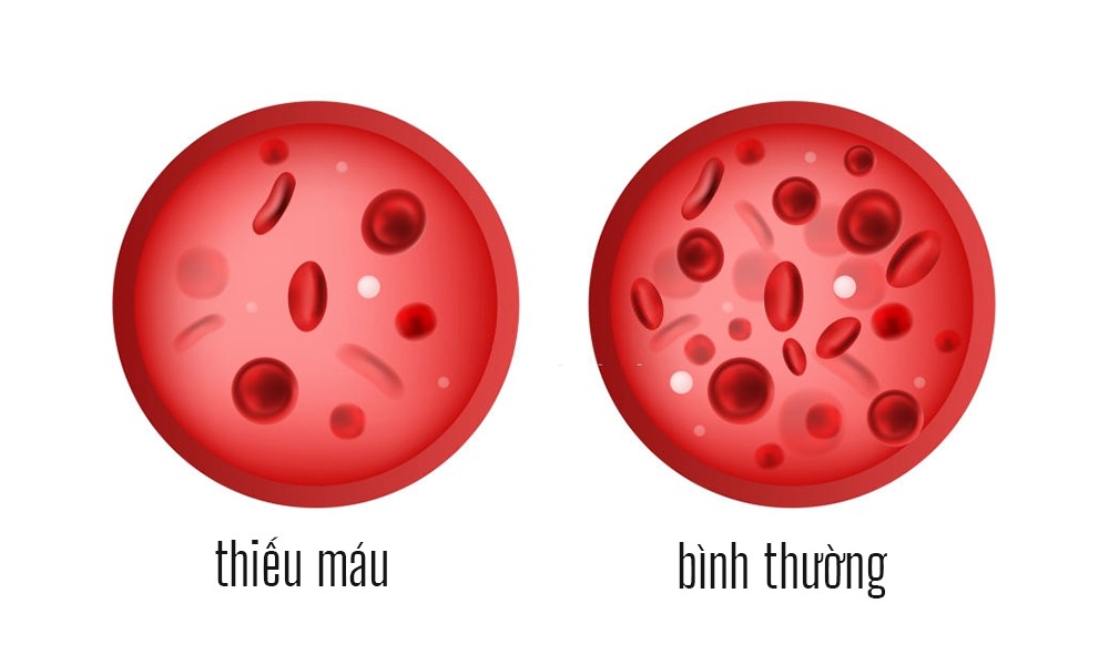 Người bị thiếu máu thiếu sắt