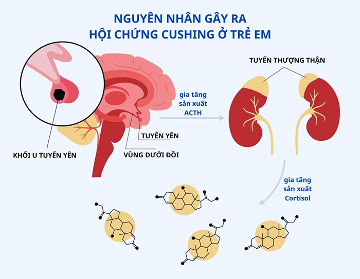 Nguyên nhân gây bệnh Cushing - u tuyến yên tiết ACTH