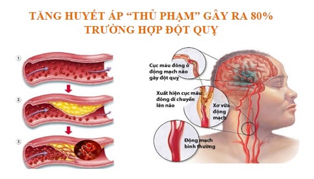 Tăng huyết áp gây tai biến
