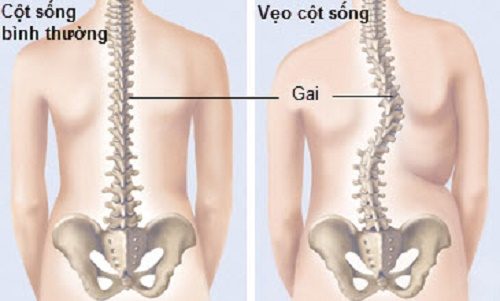 Biến dạng cột sống ảnh hưởng đến hô hấp