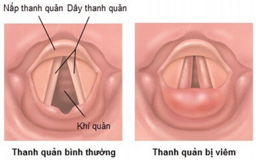 triệu chứng viêm nắp thanh quản trẻ em