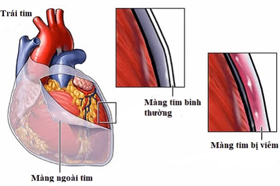 Viêm màng ngoài tim co thắt: Hiểu đúng để điều trị kịp thời 7 Nguyên nhân viêm màng ngoài tim co thắt