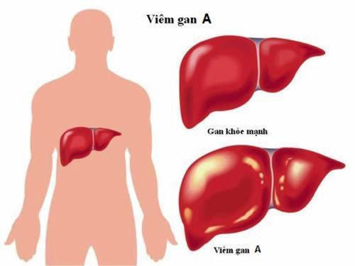 nhận biết triệu chứng viêm gan A