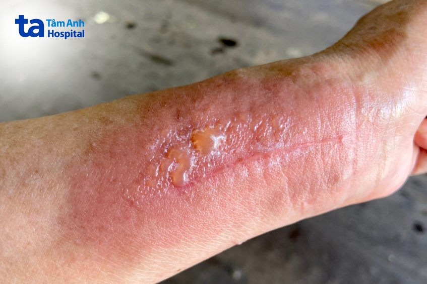 Triệu chứng viêm da tiếp xúc dị ứng