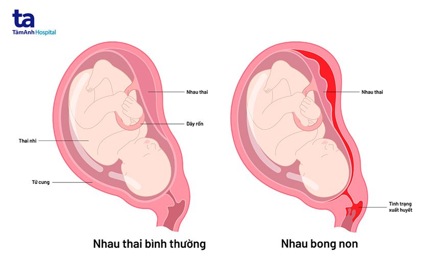 nhau bong non là gì