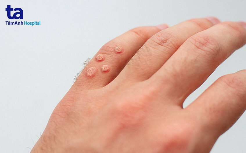 Virus HPV có thể dẫn đến các bệnh ung thư nguy hiểm nếu không điều trị sớm