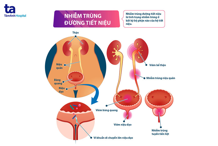 Nhiễm Trùng Đường Tiết Niệu Tái Phát: Nguyên Nhân, Triệu Chứng và Cách Điều Trị Hiệu Quả 7 vi khuẩn gây viêm đường tiết niệu
