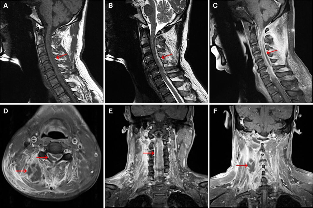MRI tủy cổ cho thấy tổn thương liên quan đến dấu hiệu Lhermitte