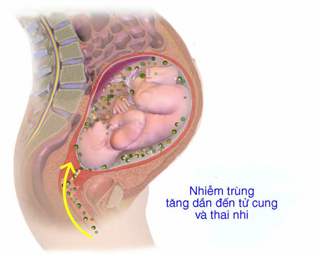 Nguyên nhân gây viêm màng ối