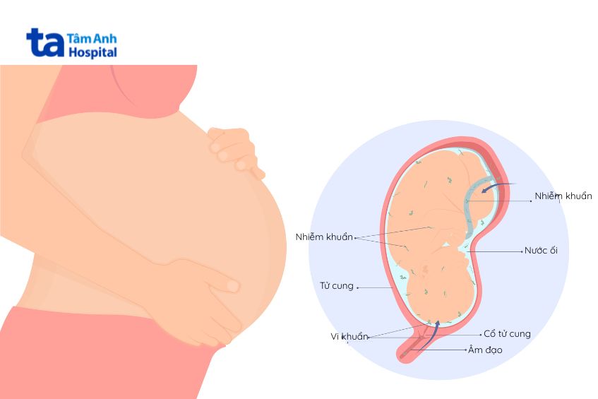 Nhiễm Trùng Ối: Nguy Cơ, Triệu Chứng Và Hướng Điều Trị Kịp Thời 8 Vỡ ối sớm do nhiễm trùng