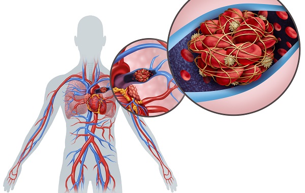 Nhồi Máu Phổi: Hiểu Đúng Để Phòng Ngừa Kịp Thời 8 Triệu chứng nhồi máu phổi ở bệnh nhân