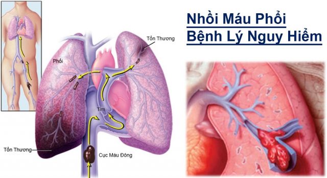 Nhồi Máu Phổi: Hiểu Đúng Để Phòng Ngừa Kịp Thời 7 Cơ chế hình thành nhồi máu phổi