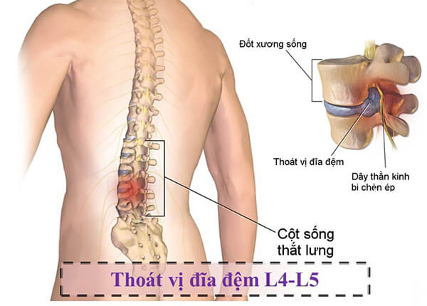 Gai đốt sống thắt lưng L4-L5