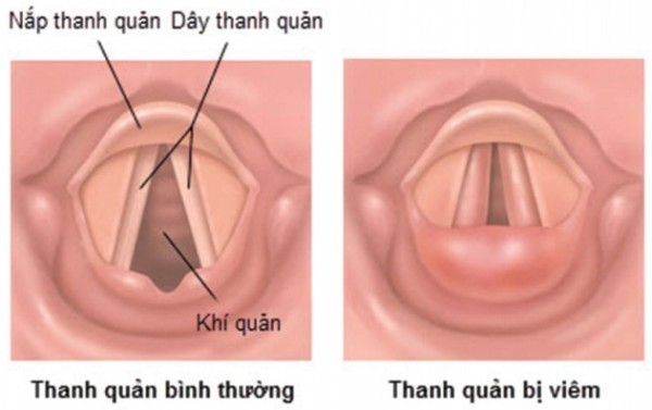 Nguyên nhân gây mất giọng thường gặp