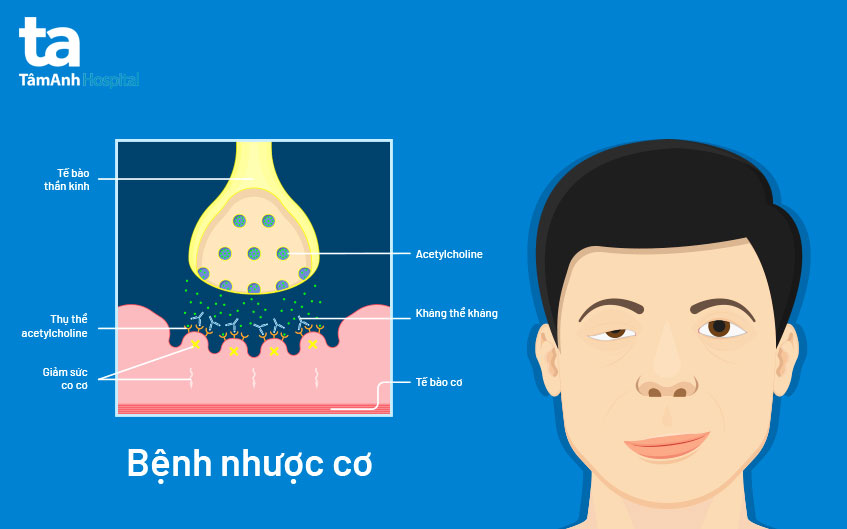 Hình ảnh minh họa bệnh nhược cơ