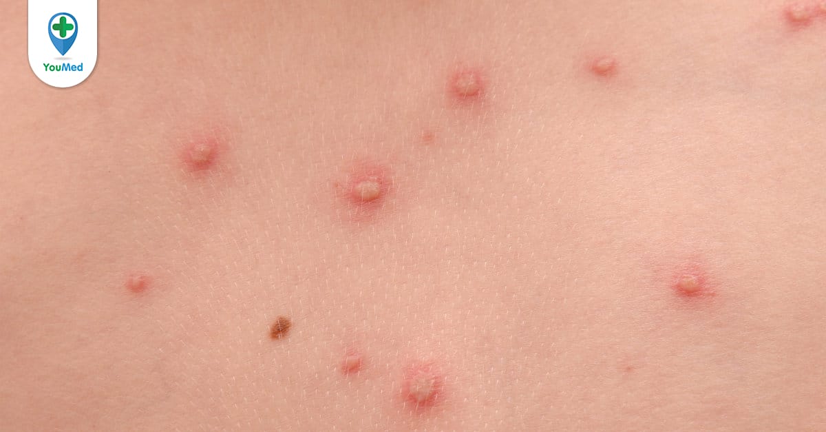 Nổi mụn nước trên tay