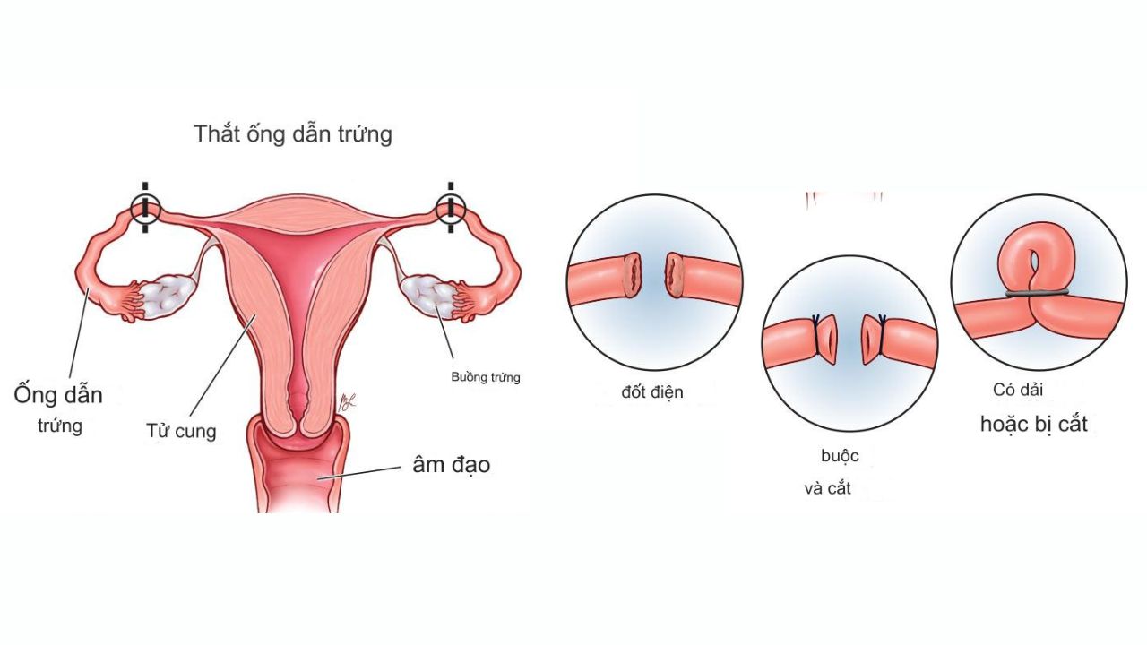 Phẫu thuật vi phẫu nối vòi trứng