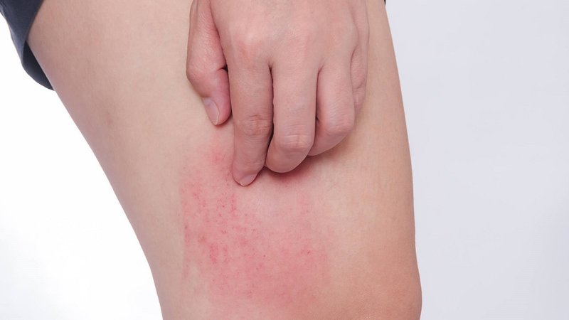 Da bị tăng sừng và dày lên