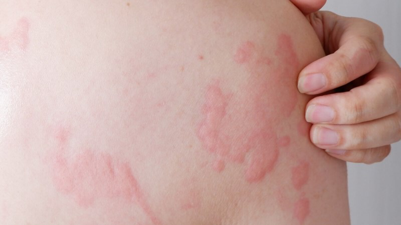Mày Đay Cấp Tính: Nguyên Nhân, Triệu Chứng và Hướng Điều Trị Hiệu Quả 8 Nguyên nhân gây mày đay cấp tính