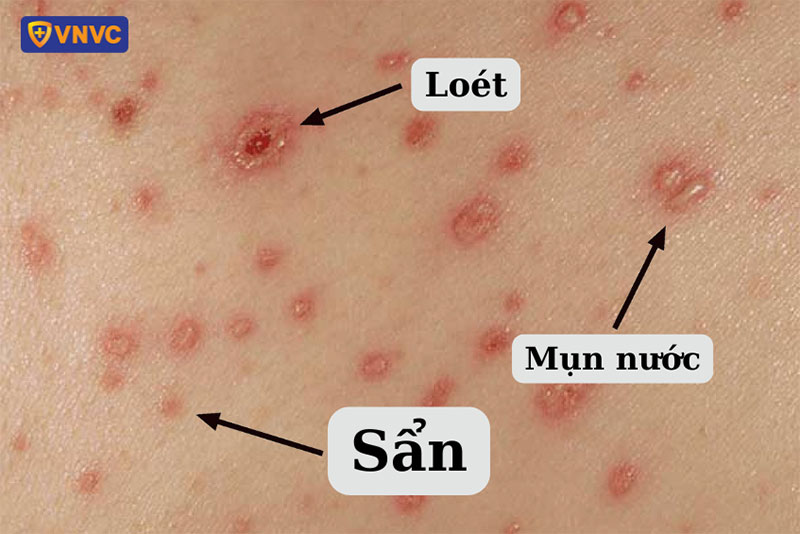Phát ban thủy đậu ở trẻ em