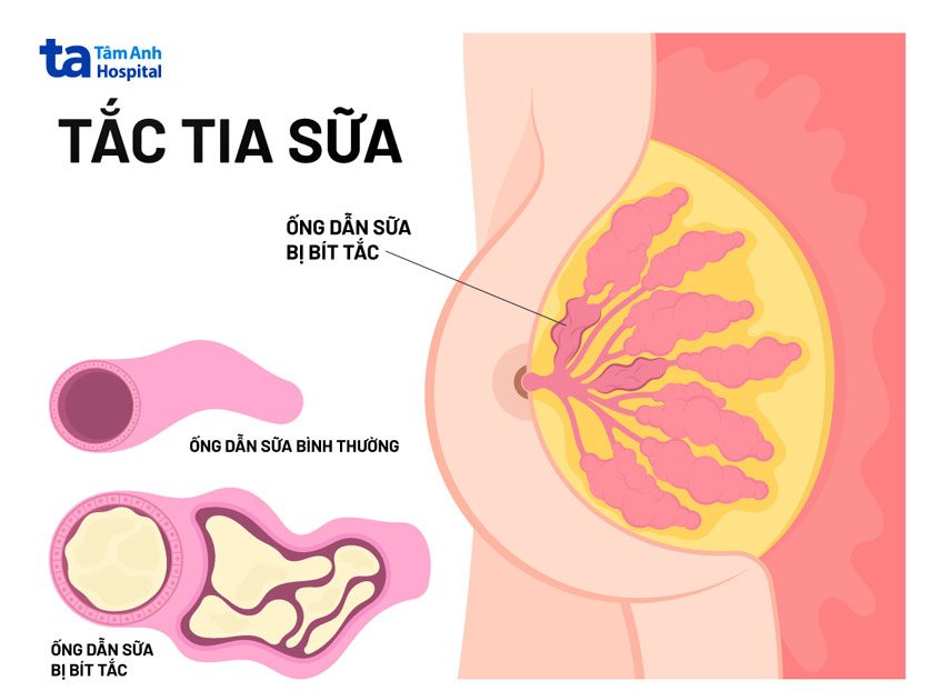 Áp Xe Vú: Biến Chứng Nguy Hiểm Sau Viêm Tuyến Vú Cần Nhận Biết Sớm 8 Dẫn lưu áp xe vú