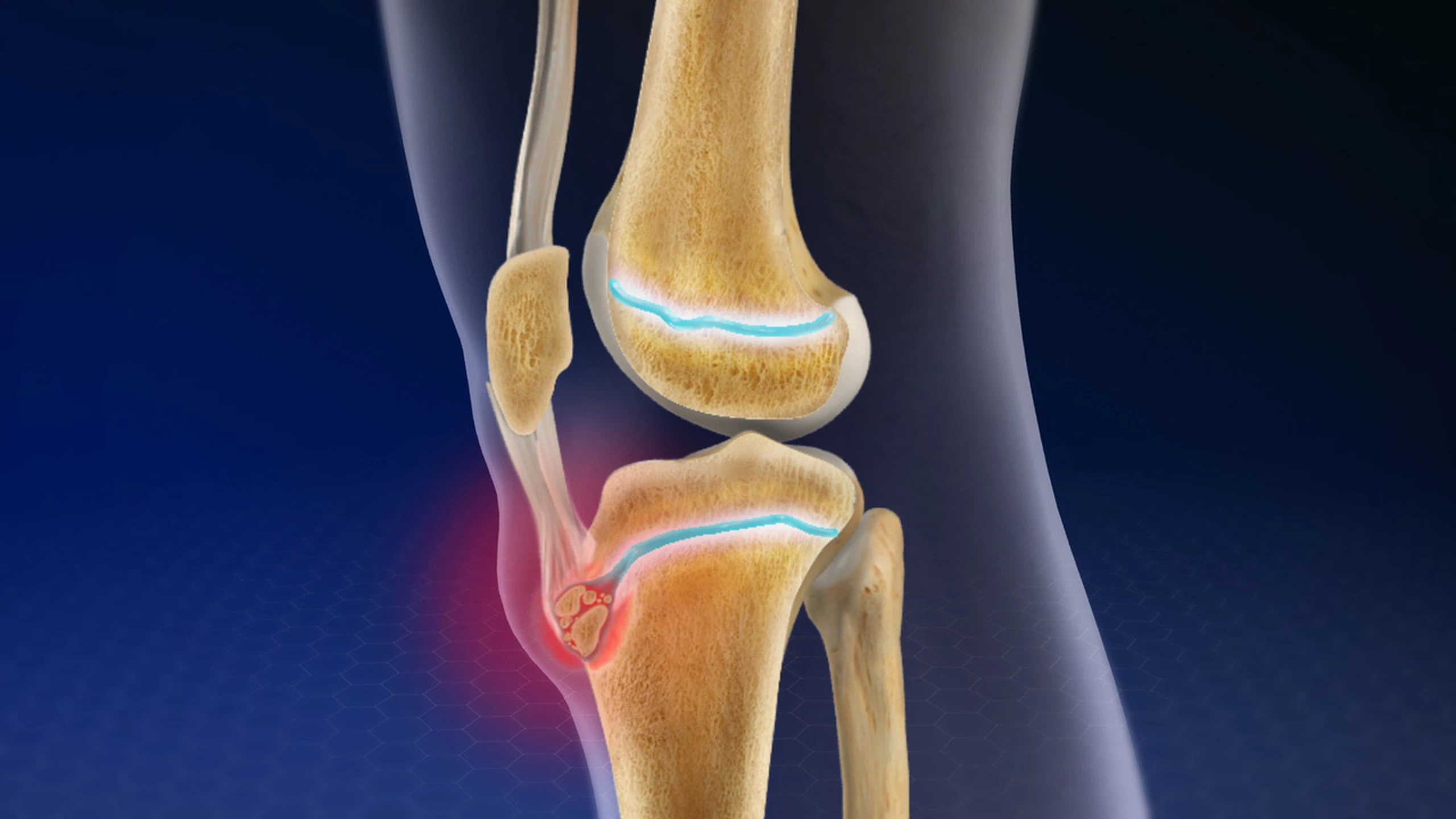 Bệnh Osgood-Schlatter: Nguyên nhân, triệu chứng và cách điều trị hiệu quả 4 Vị trí đau của bệnh Osgood-Schlatter
